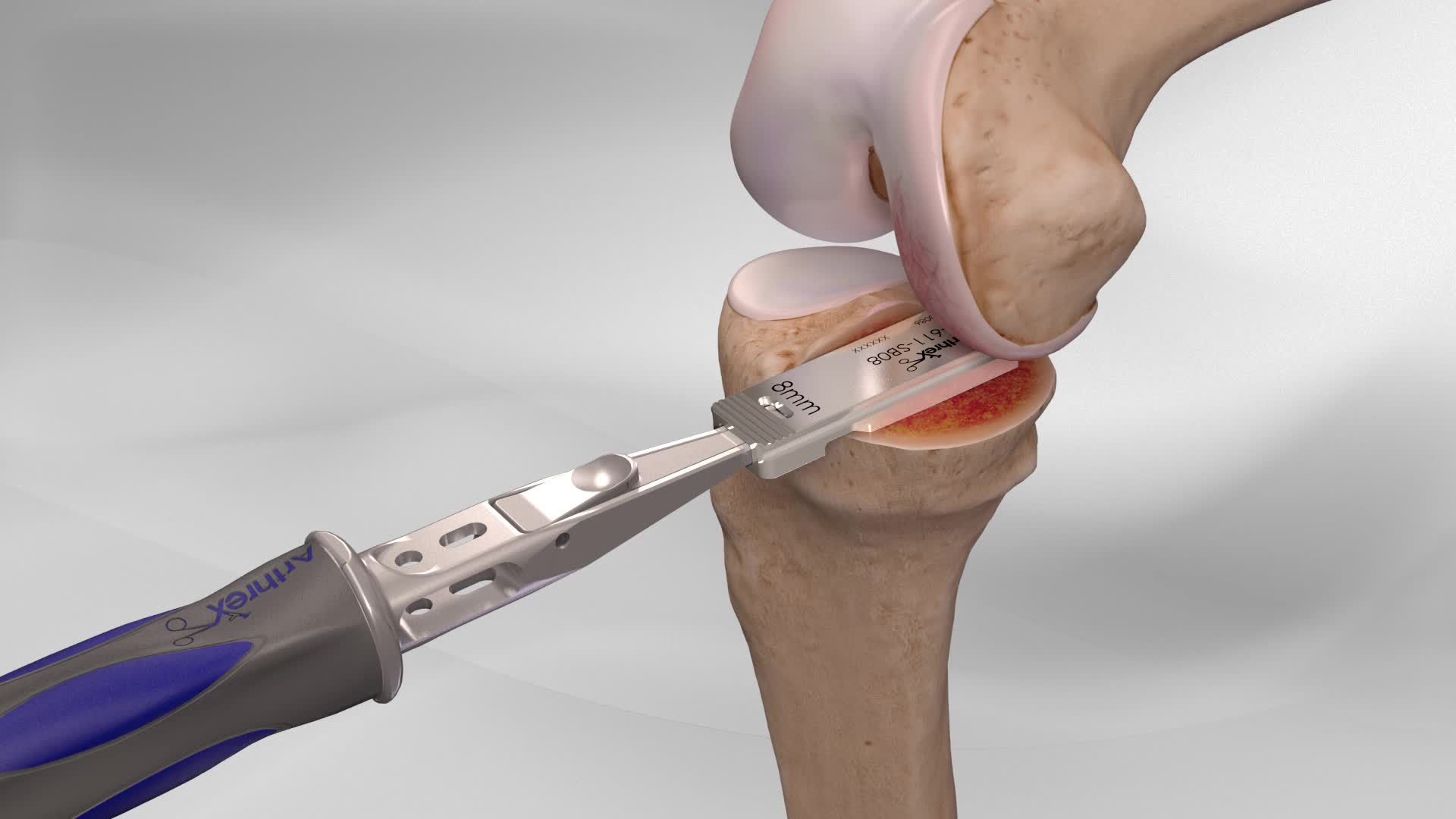 Partial Knee Replacement with the iBalance