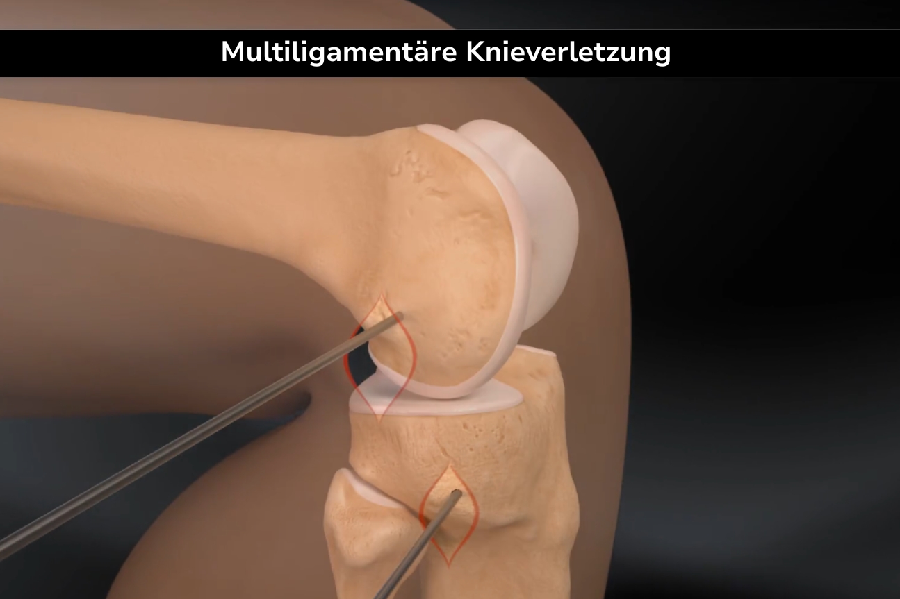 multiligamentäre knieverletzung